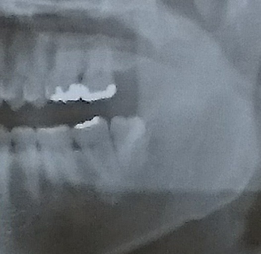faced_to_death_because_wisdom_tooth_3_crop_sh